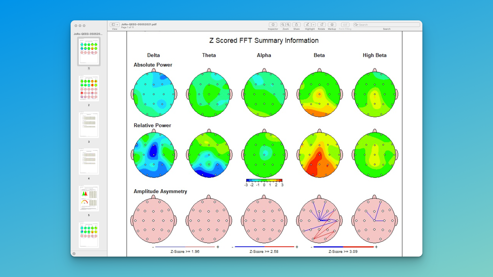 linked ears qeeg analysis