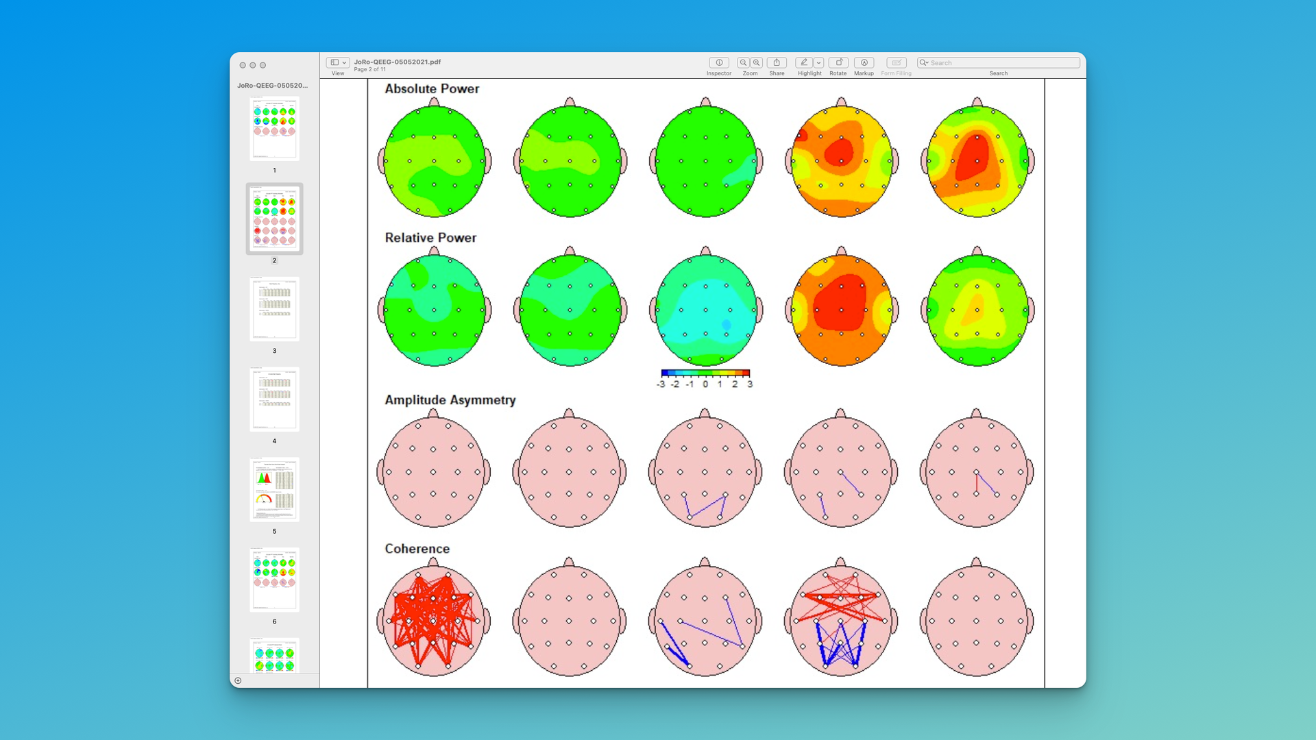 laplacian qeeg analysis