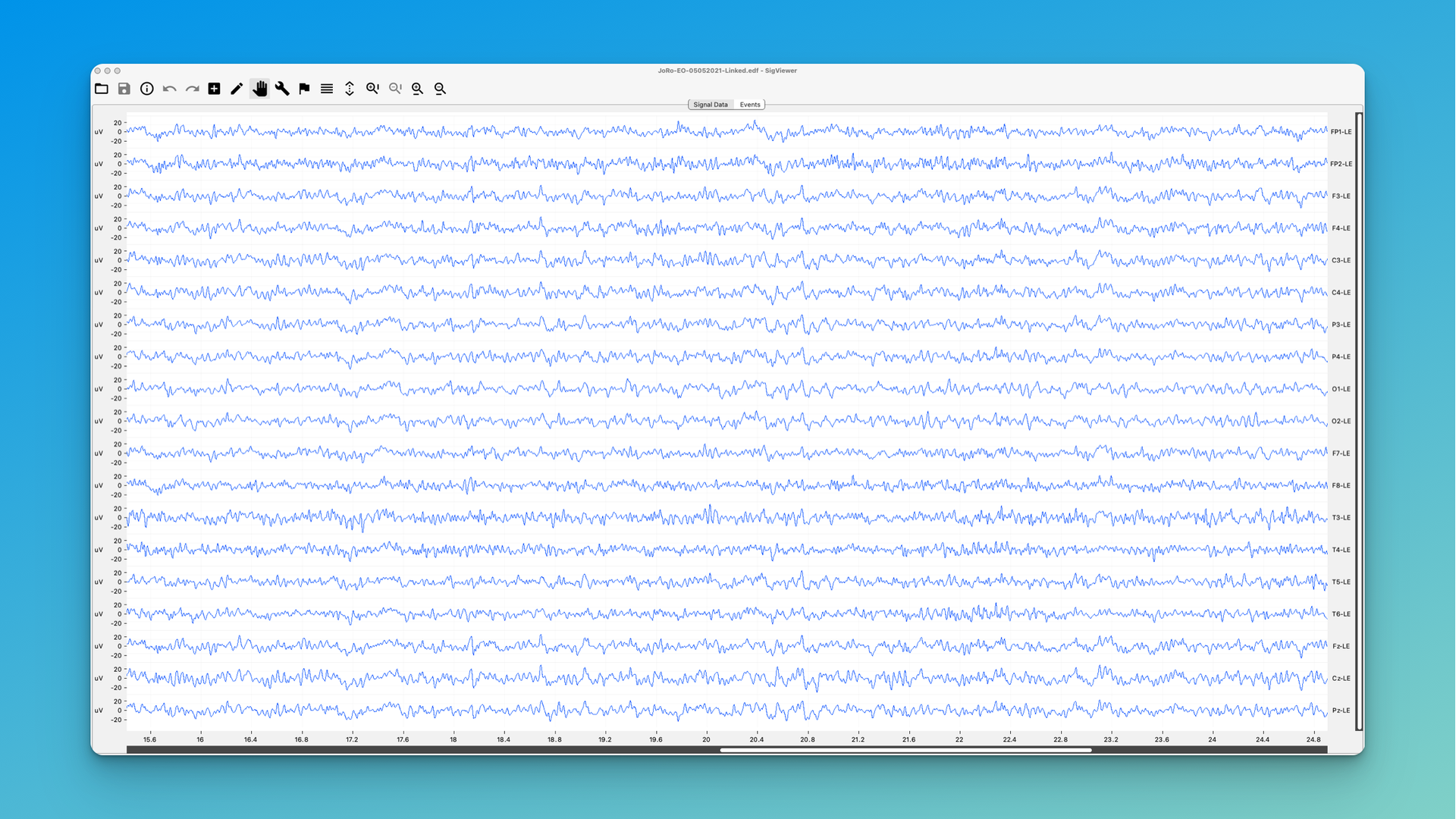 spindling excessive beta